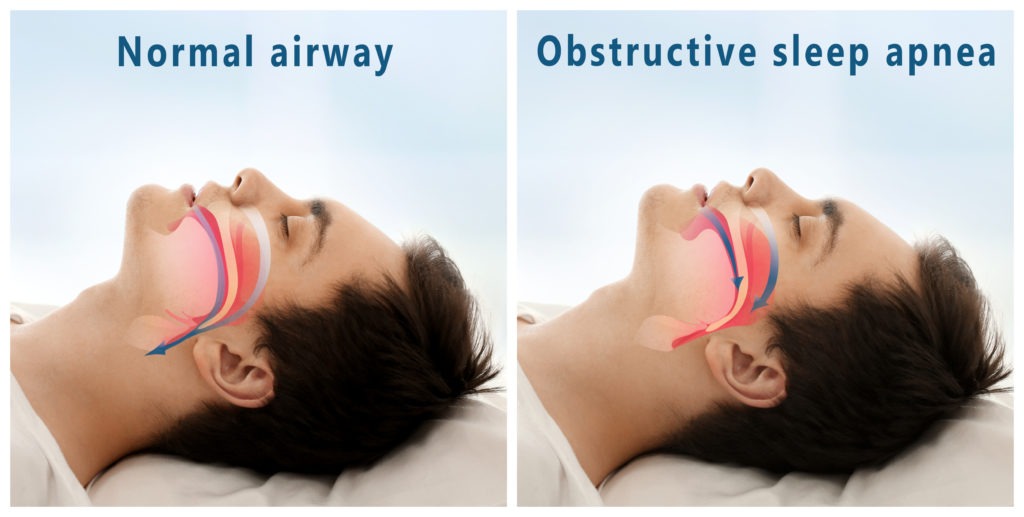 Obstructive Sleep Apnea Illustrated