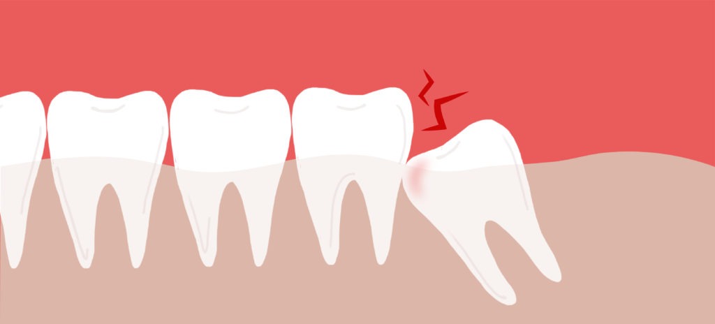 graphic showing wisdom tooth effects